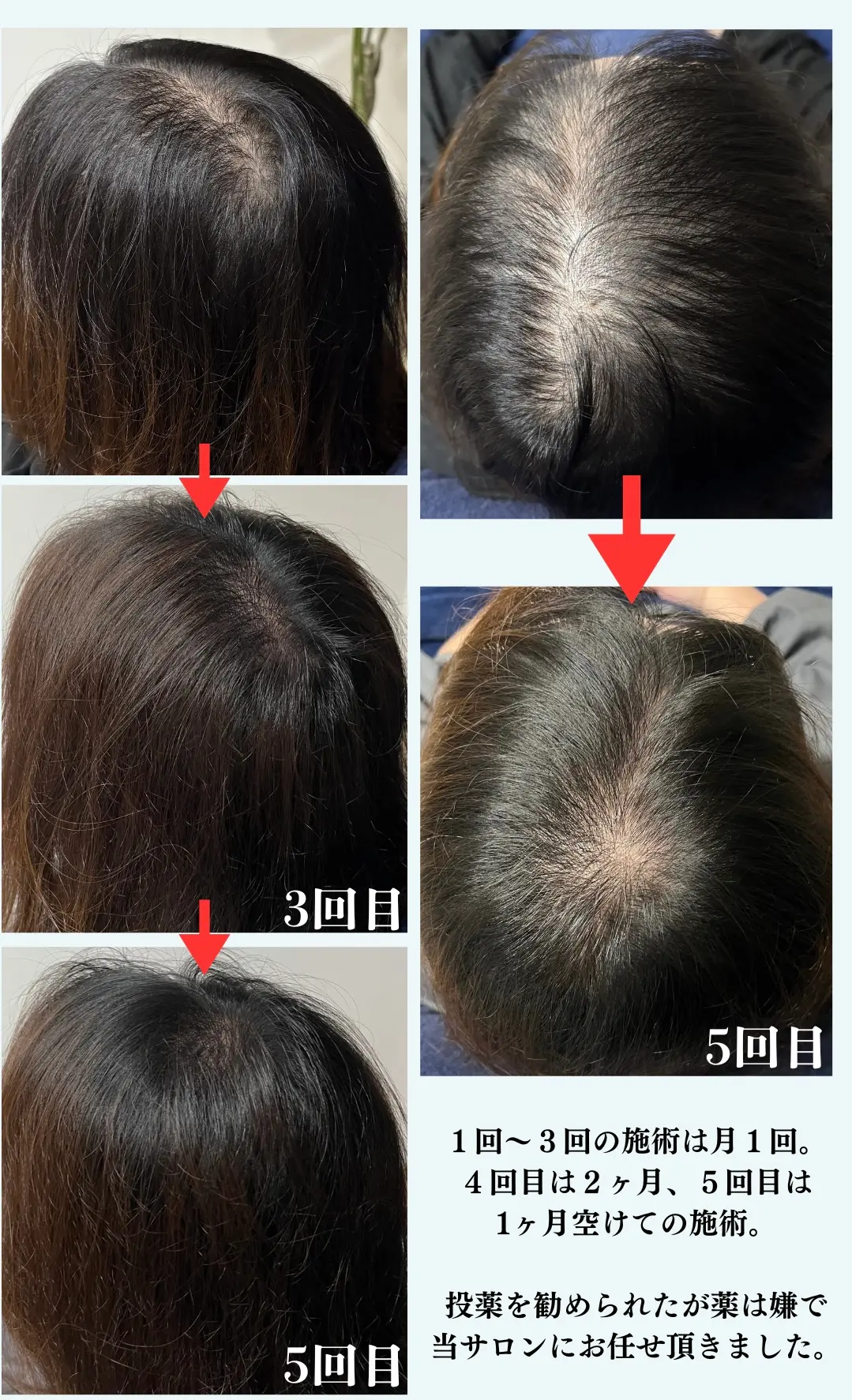 HAIR GROWTH 女性ビフォーアフター