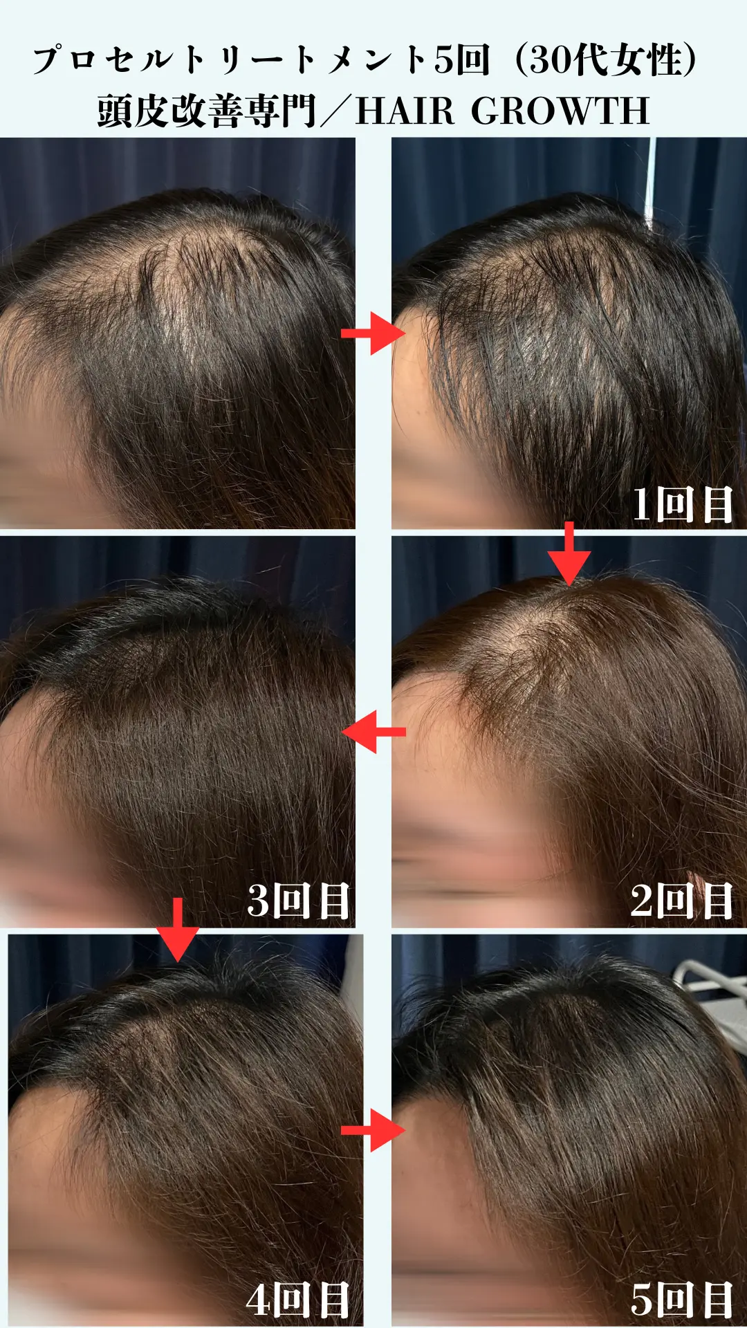 HAIR GROWTH 女性ビフォーアフター