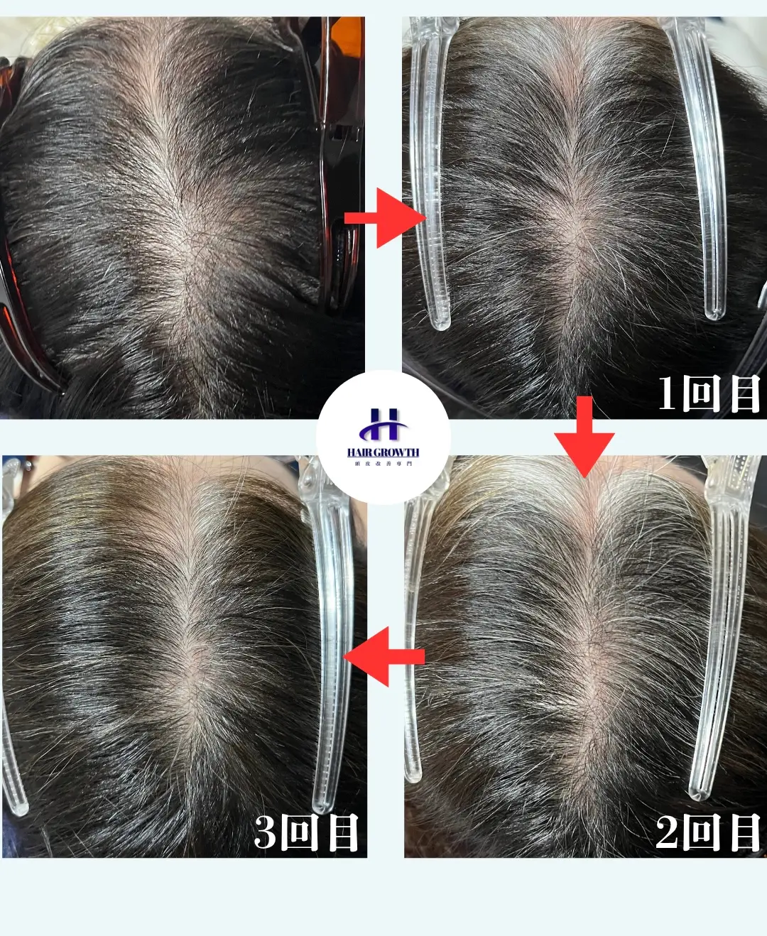 HAIR GROWTH 女性ビフォーアフター