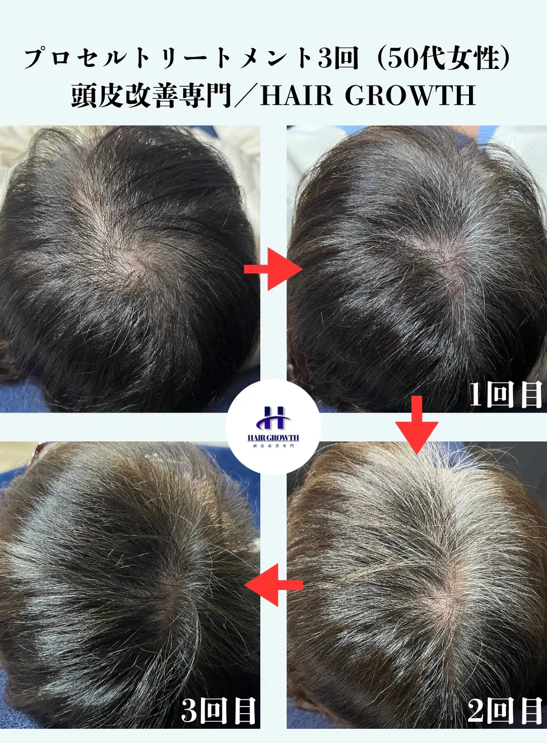HAIR GROWTH 女性ビフォーアフター