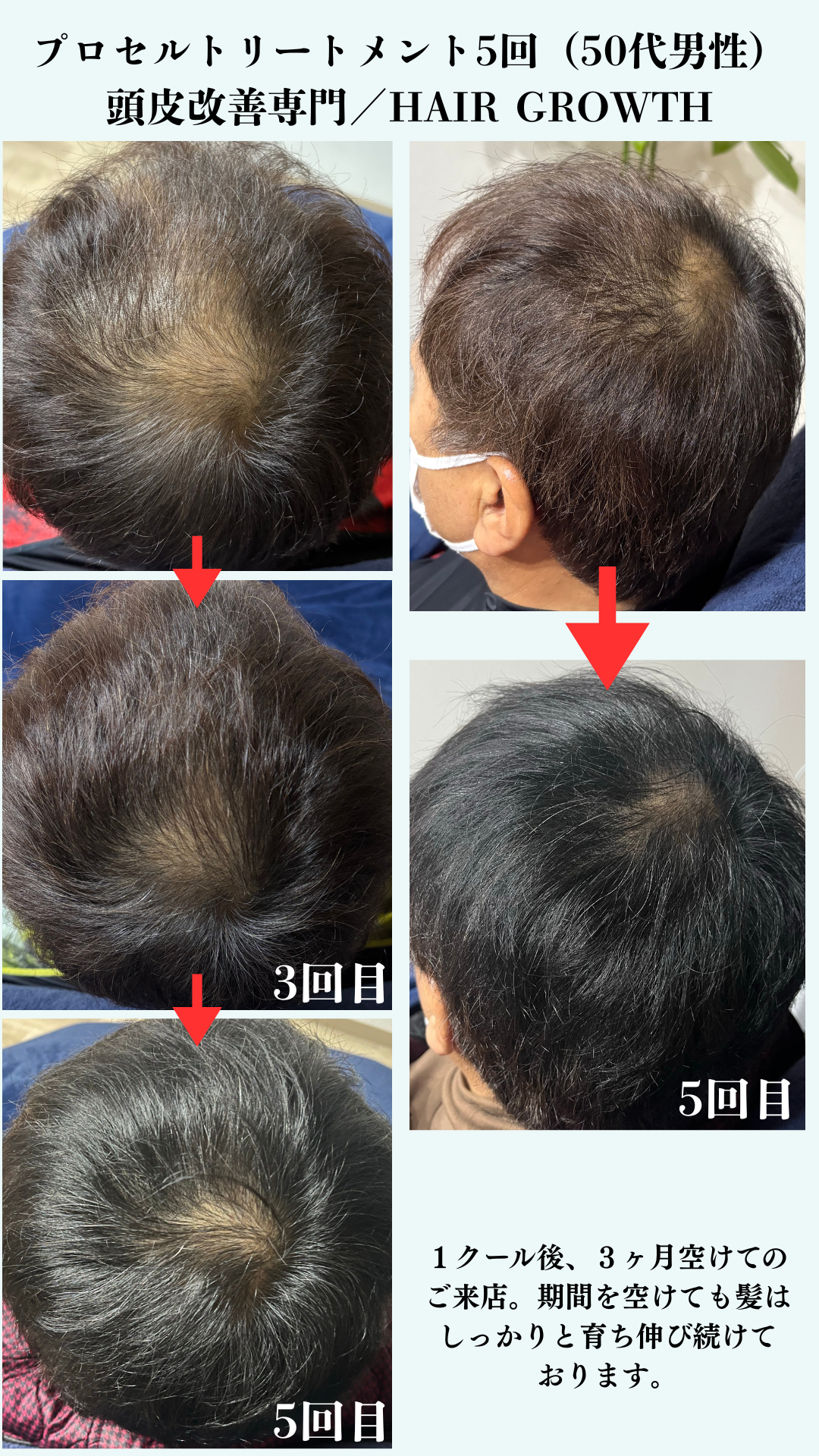 HAIR GROWTH ビフォーアフター