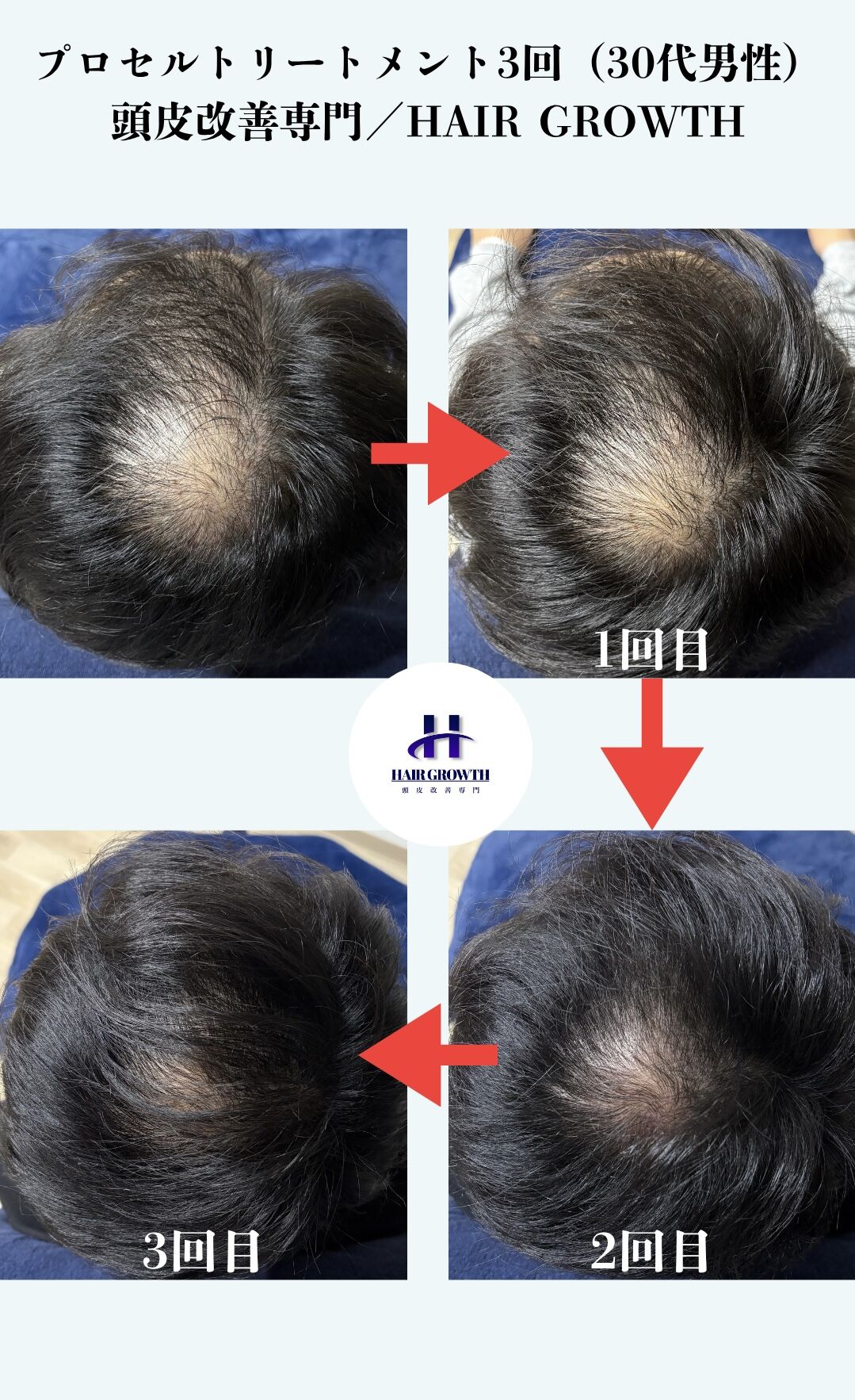 HAIR GROWTH ビフォーアフター