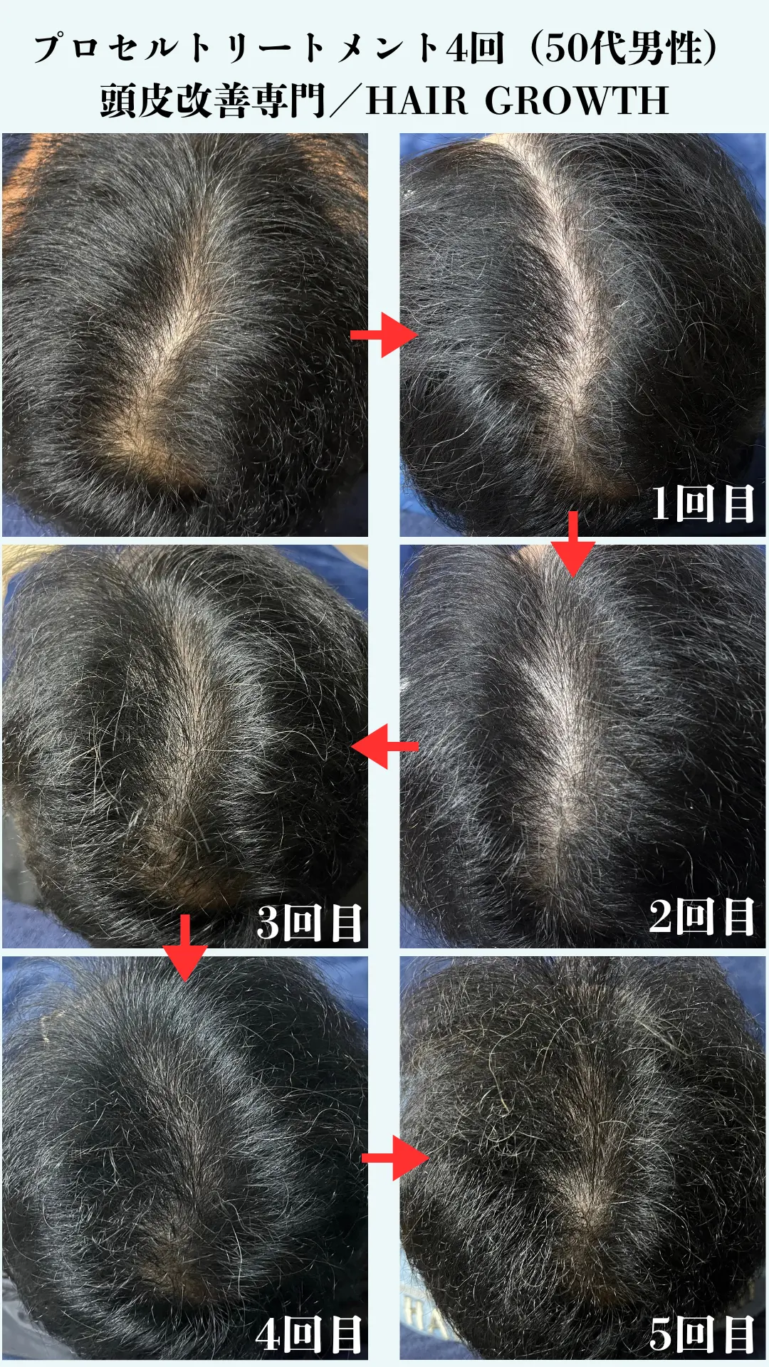 HAIR GROWTH ビフォーアフター