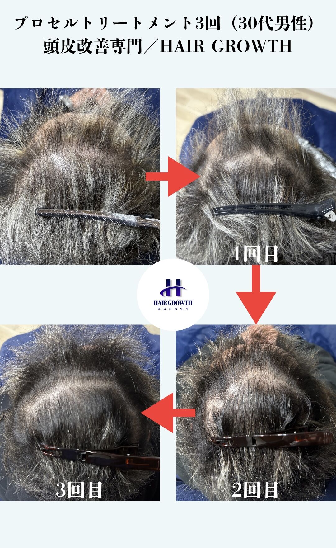 HAIR GROWTH ビフォーアフター