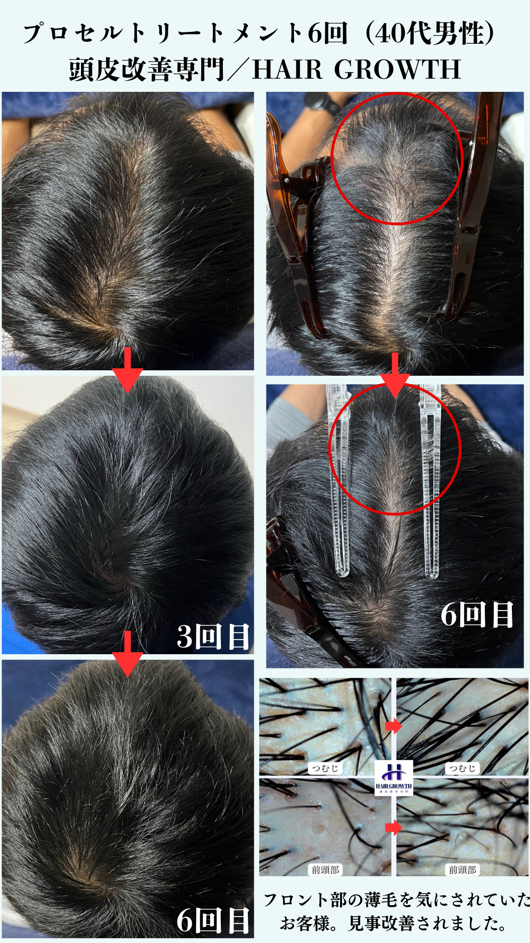 HAIR GROWTH ビフォーアフター